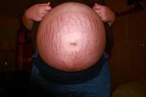 Picture of a pregnant women's belly full of stretch marks in red color