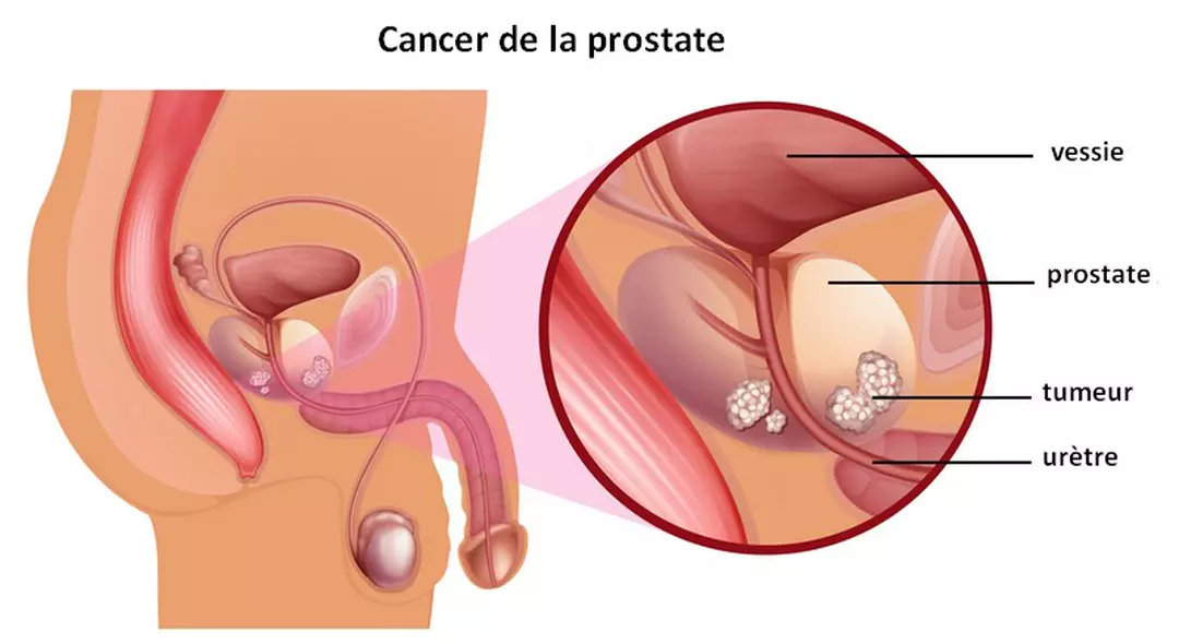 Maladie Cancer de Prostate